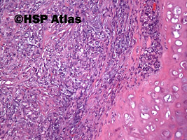 5. Spindle cell carcinoma - sarcomatoid carcinoma, 10x