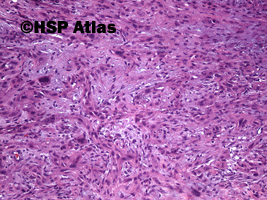 6. Rak wrzecionowatokomórkowy - mięsakorak (spindle cell carcinoma - sarcomatoid carcinoma), 10x