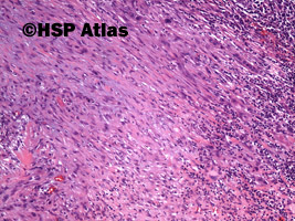 7. Rak wrzecionowatokomórkowy - mięsakorak (spindle cell carcinoma - sarcomatoid carcinoma), 10x