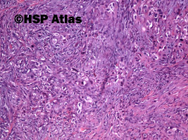 8. Rak wrzecionowatokomórkowy - mięsakorak (spindle cell carcinoma - sarcomatoid carcinoma), 10x