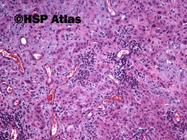 9. Rak wrzecionowatokomórkowy - mięsakorak (spindle cell carcinoma - sarcomatoid carcinoma), 10x