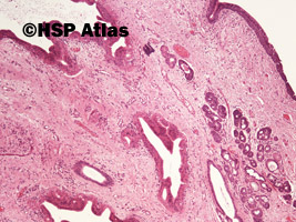 4. Torbiel onkocytarna (oncocytic cyst), 4x