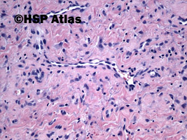 4. Naczyniakowłókniak młodzieńczy (juvenile angiofibroma), guz nosogardła, 24 lata, 20x