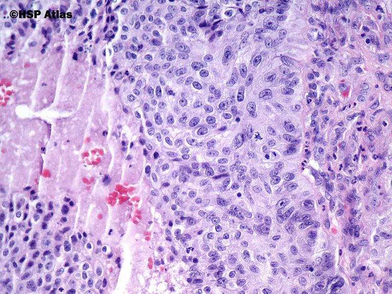 sinonasal papilloma with dysplasia endometrial cancer and estrogen