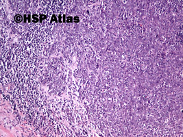 2. Rak nosogardła (nonkeratinizing nasopharyngeal carcinoma - undifferentiated), 10x