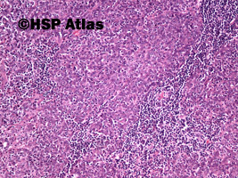 3. Rak nosogardła (nonkeratinizing nasopharyngeal carcinoma - undifferentiated), 10x