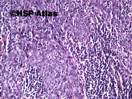 4. Rak nosogardła (nonkeratinizing nasopharyngeal carcinoma - undifferentiated), 20x