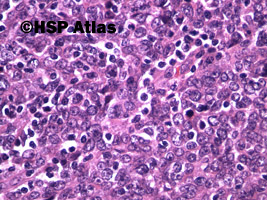 6. Rak nosogardła (nonkeratinizing nasopharyngeal carcinoma - undifferentiated), 40x