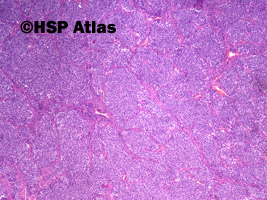1. Nerwiak węchowy zarodkowy (olfactory neuroblastoma), 4x