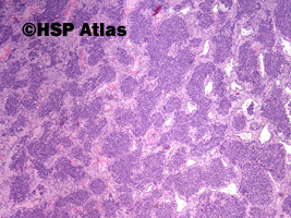 2. Nerwiak węchowy zarodkowy (olfactory neuroblastoma), 4x