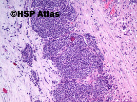 3. Nerwiak węchowy zarodkowy (olfactory neuroblastoma), 10x