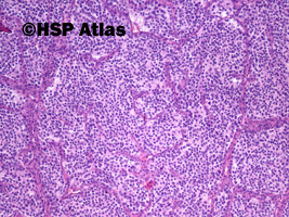 4. Nerwiak węchowy zarodkowy (olfactory neuroblastoma), 10x