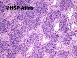 5. Nerwiak węchowy zarodkowy (olfactory neuroblastoma), 10x