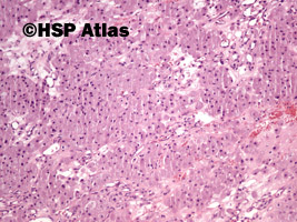 4. Congenital granular cell tumor, 10x