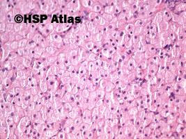 5. Congenital granular cell tumor, 20x