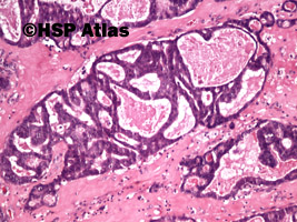 10. Adenocarcinoma, parotid gland, 10x