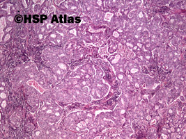 2. Adenocarcinoma, parotid gland, 4x
