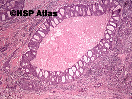 3. Adenocarcinoma, parotid gland, 4x
