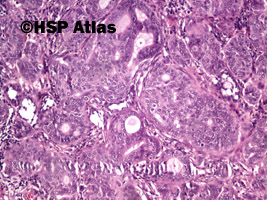 9. Adenocarcinoma, parotid gland, 10x