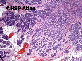 1. Rak gruczołowo-torbielowaty (adenoid cystic carcinoma), 4x