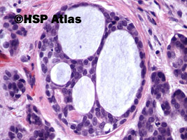 12. Rak gruczołowo-torbielowaty (adenoid cystic carcinoma), 40x