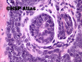 13. Rak gruczołowo-torbielowaty (adenoid cystic carcinoma), 40x
