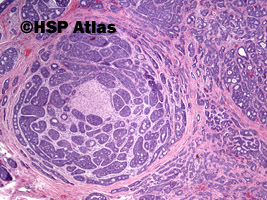 2. Rak gruczołowo-torbielowaty (adenoid cystic carcinoma), 4x
