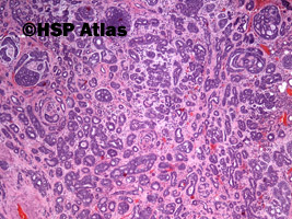 3. Rak gruczołowo-torbielowaty (adenoid cystic carcinoma), 4x