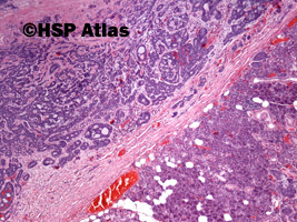 5. Rak gruczołowo-torbielowaty (adenoid cystic carcinoma), 4x