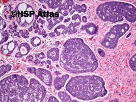6. Rak gruczołowo-torbielowaty (adenoid cystic carcinoma), 10x