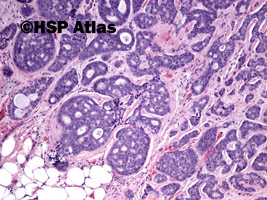8. Rak gruczołowo-torbielowaty (adenoid cystic carcinoma), 10x