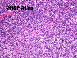 2. Basal cell adenoma, guz ślinianki, 10x