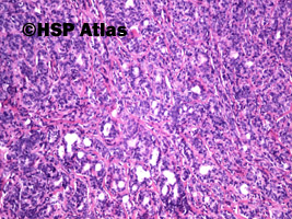 3. Basal cell adenoma, guz ślinianki