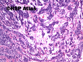 5. Basal cell adenoma, guz ślinianki, 10x