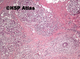 2. Choroba Mikulicza (Mikulicz disease - benign lymphoepithelial lesion), 4x