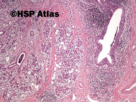 3. Choroba Mikulicza (Mikulicz disease - benign lymphoepithelial lesion), 4x
