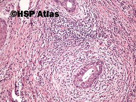 4. Choroba Mikulicza (Mikulicz disease - benign lymphoepithelial lesion), 10x