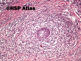 5. Choroba Mikulicza (Mikulicz disease - benign lymphoepithelial lesion), 10x
