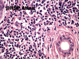 8. Choroba Mikulicza (Mikulicz disease - benign lymphoepithelial lesion), 40x