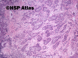 1. Rak śluzowo-naskórkowy (mucoepidermoid carcinoma), 4x