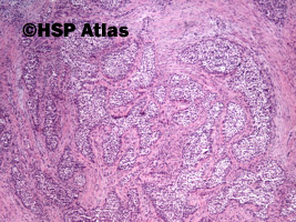 2. Rak śluzowo-naskórkowy (mucoepidermoid carcinoma), 4x