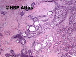 3. Rak śluzowo-naskórkowy (mucoepidermoid carcinoma), 4x