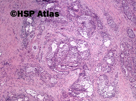 4. Rak śluzowo-naskórkowy (mucoepidermoid carcinoma), 4x