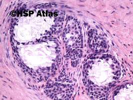 7. Rak śluzowo-naskórkowy (mucoepidermoid carcinoma), 20x