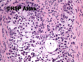 8. Rak śluzowo-naskórkowy (mucoepidermoid carcinoma), 20x