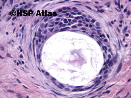 9. Rak śluzowo-naskórkowy (mucoepidermoid carcinoma), 40x