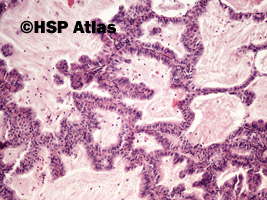 5. Gruczolakorak (adenocarcinoma), 10x