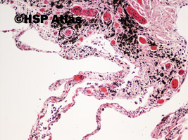 5. Anthracosis, 10x
