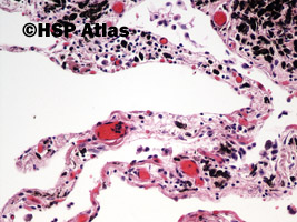 7. Anthracosis, 20x