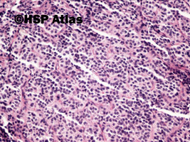 7. Rakowiak oskrzela (carcinoid tumor), 20x